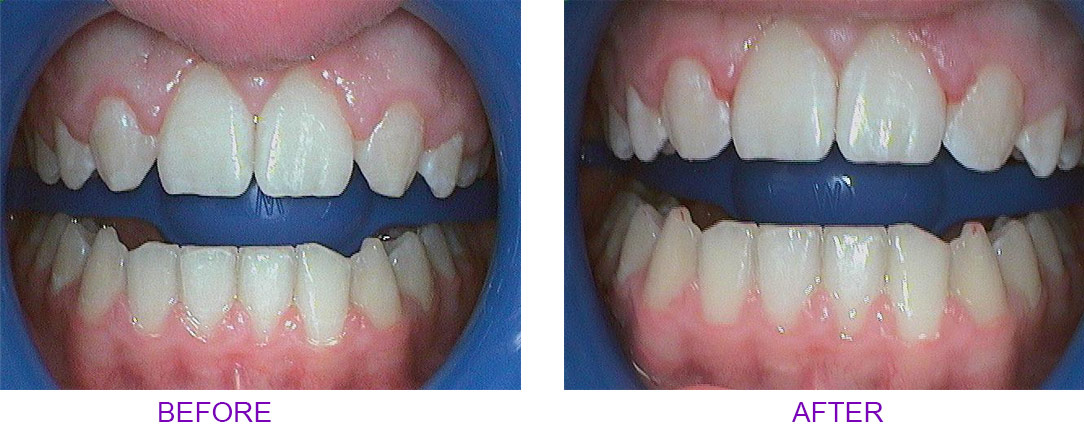 before and after veneers