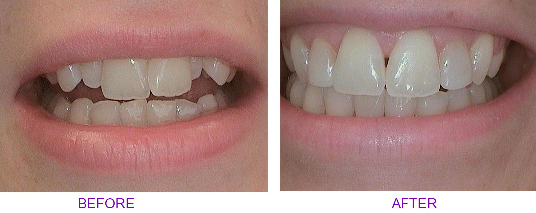 before and after veneers