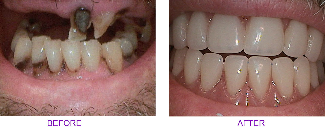 before and after dentures