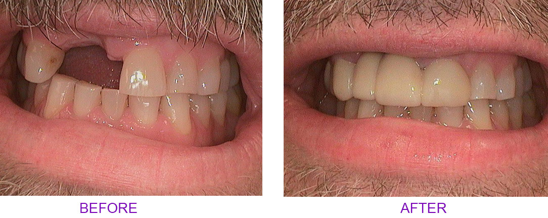 before and after bridge