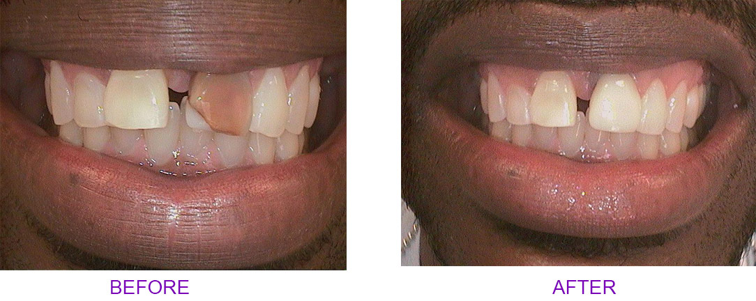 before and after crown