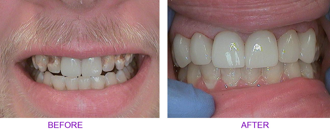 before and after crown