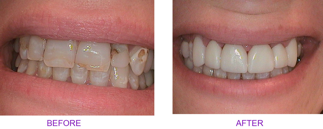 before and after crown
