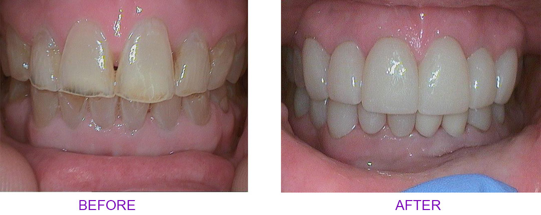 before and after crown