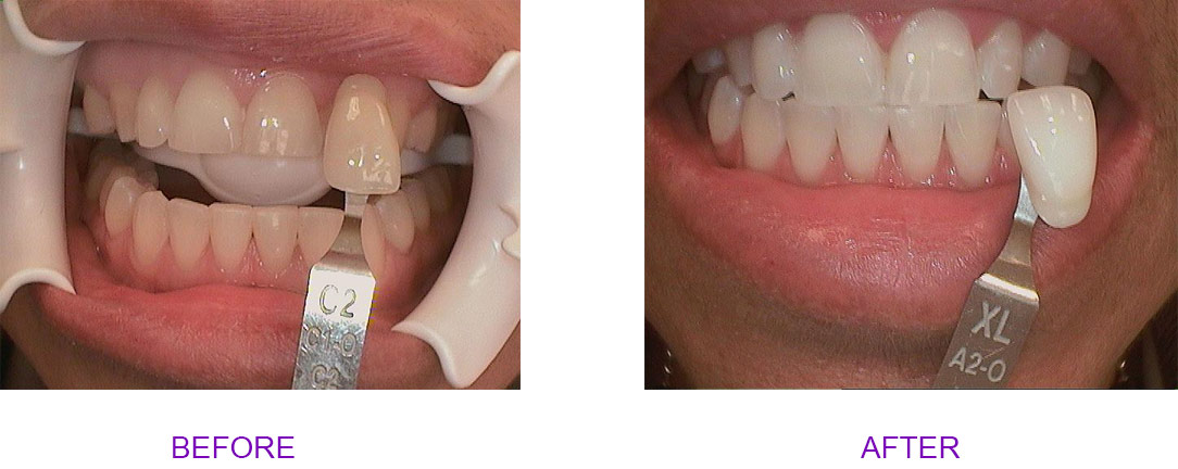before and after teeth whitening