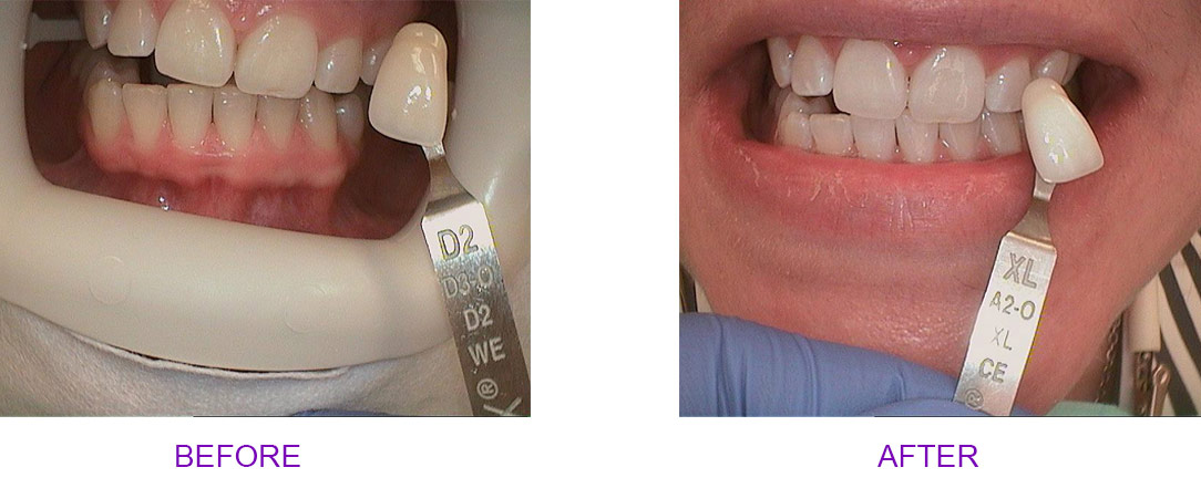 before and after teeth whitening